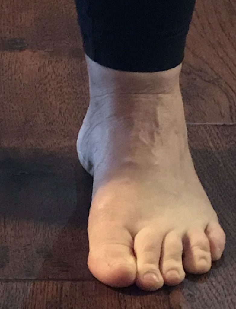 Lateral Foot Pain With Lump